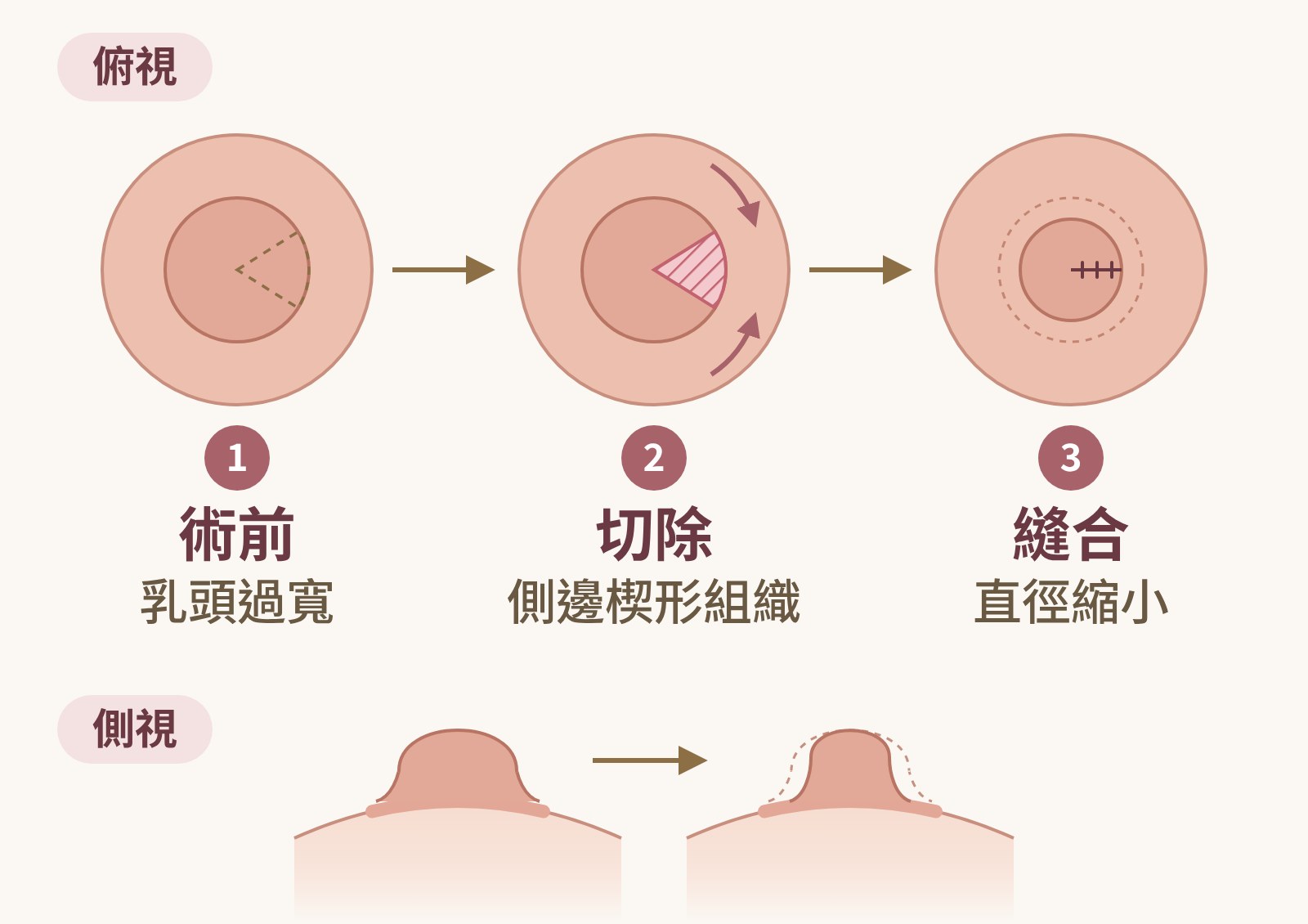 縮乳頭手術楔形切法圖解：俯視與側視，術前乳頭過寬，從側邊切除一塊楔形組織，縫合後乳頭直徑縮小｜妍回美學診所