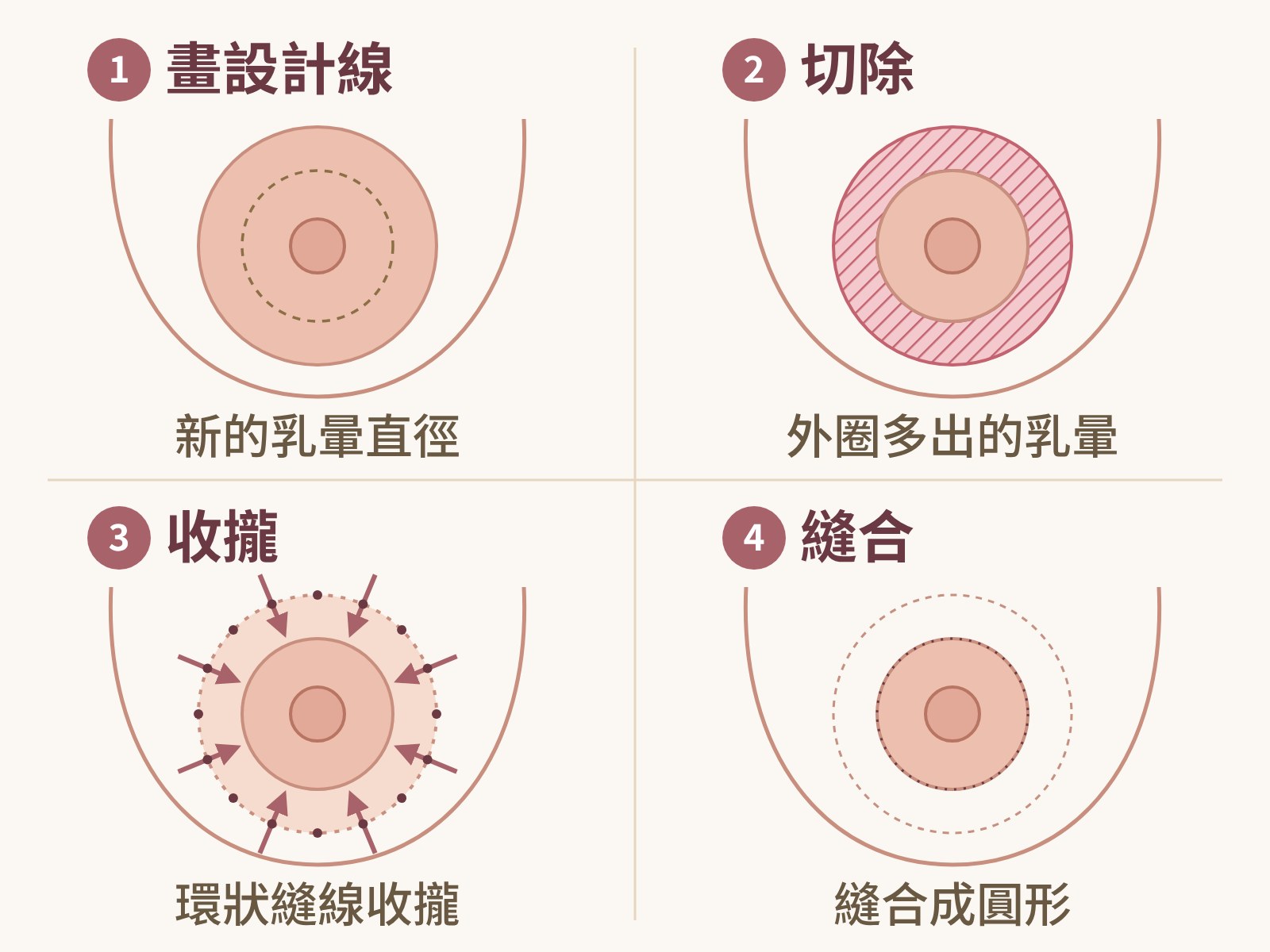 乳暈縮小手術乳暈外緣環切圖解：畫出新的乳暈直徑、切除外圈多出的乳暈、環狀縫線收攏外圈皮膚、縫合成圓形｜妍回美學診所