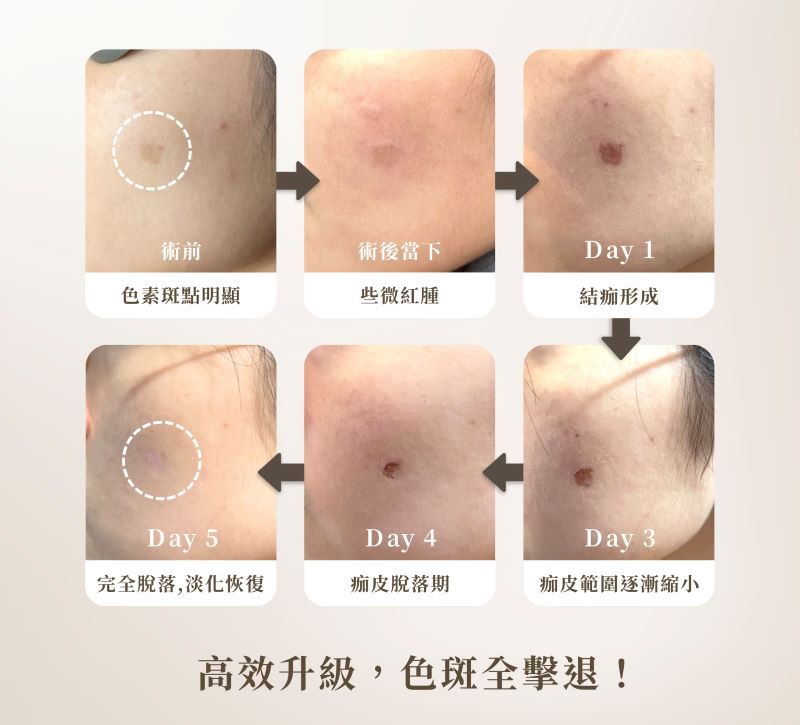 鉑金蜂巢皮秒術後恢復期實拍｜術前・術後當下・Day1・Day3・Day4・Day5｜妍回美學診所